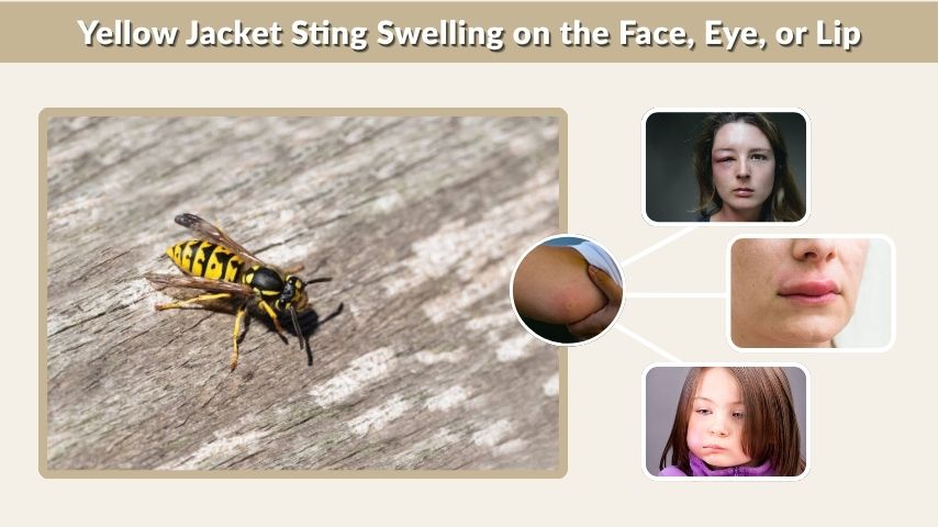 Yellow Jacket Sting Swelling on the Face, Eye, or Lip