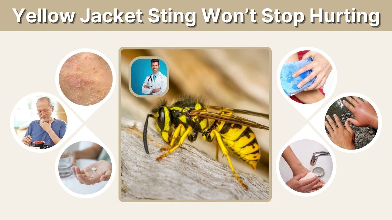 Yellow Jacket Sting Won’t Stop Hurting: What It Means and What to Do