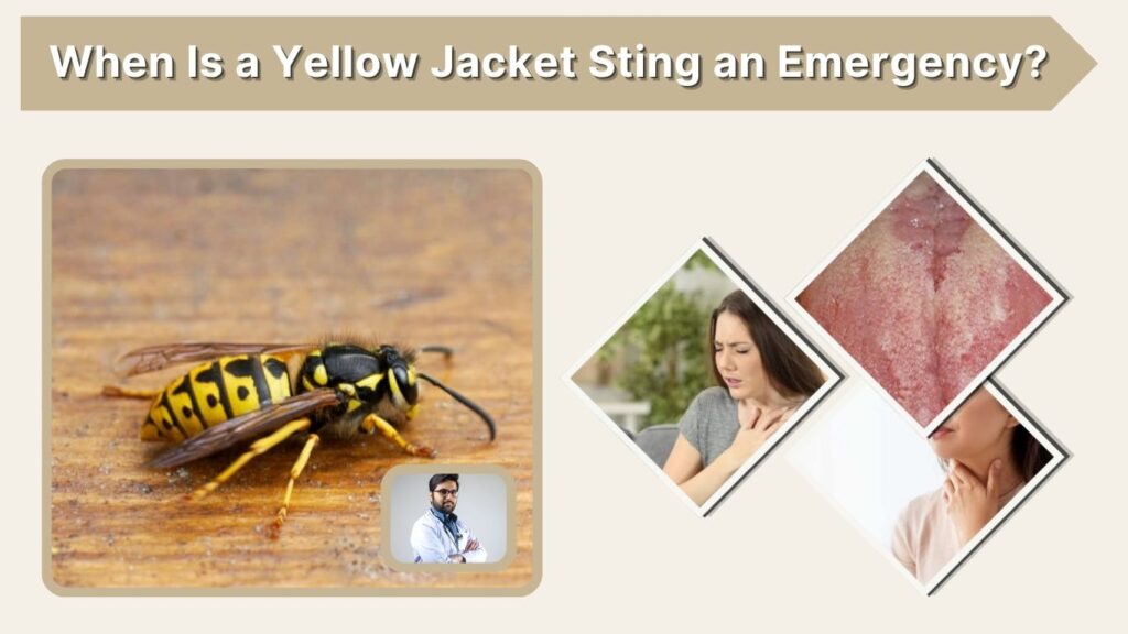 When Is a Yellow Jacket Sting an Emergency?