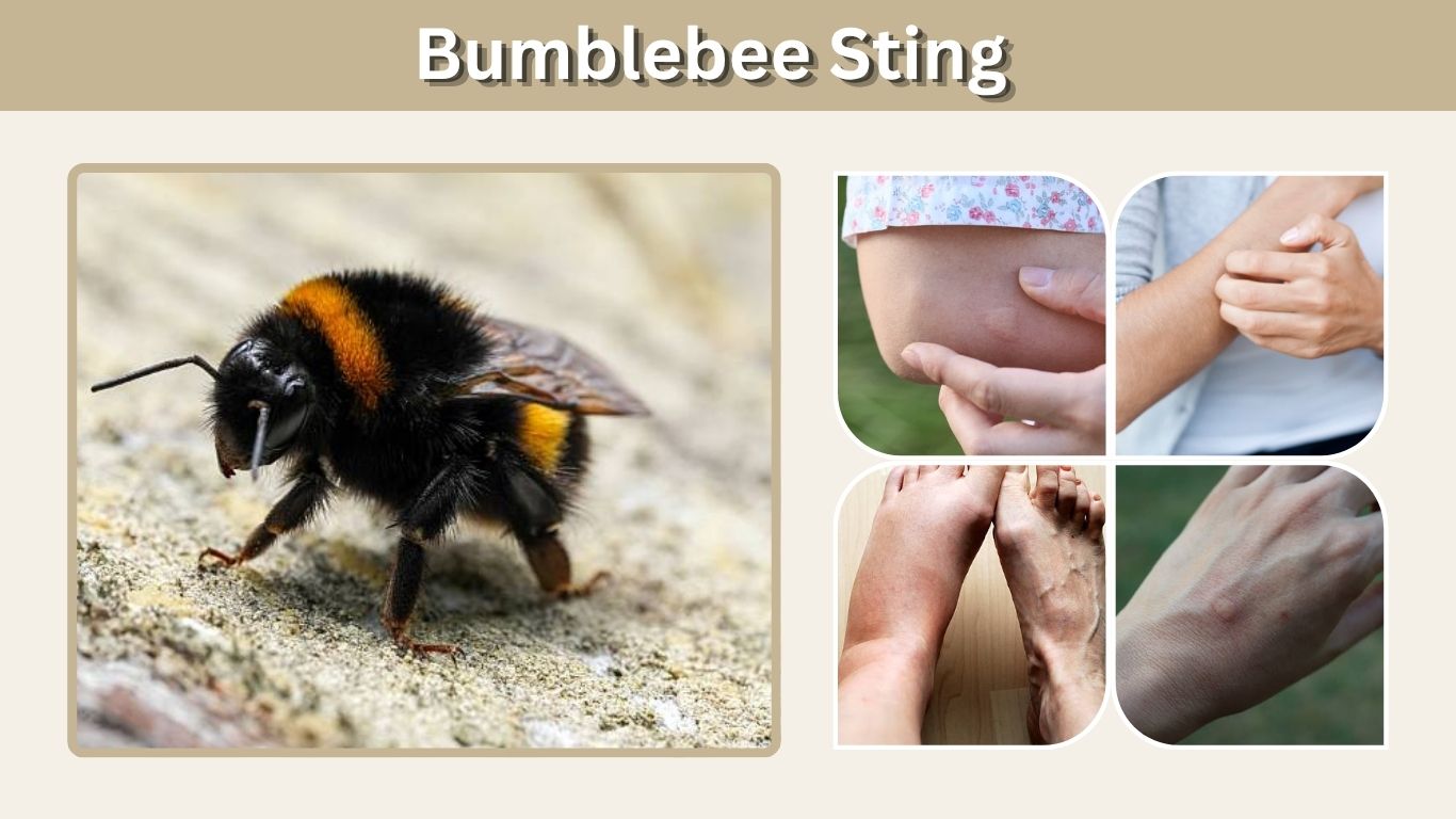 Bumblebee Sting: Symptoms, Treatment, Pain & Reactions