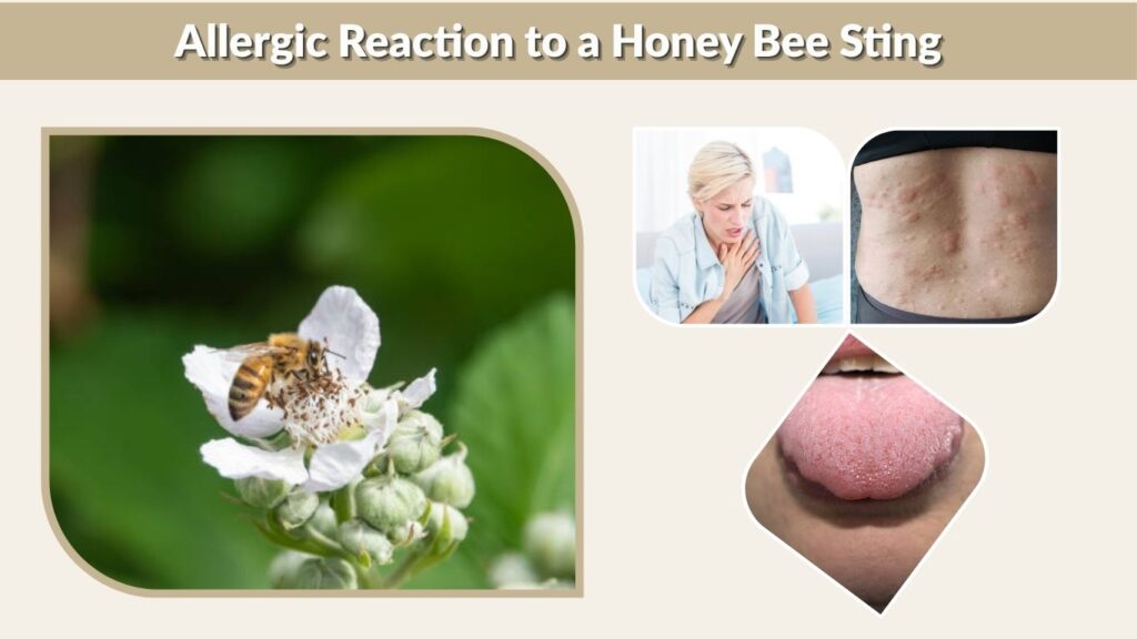 Allergic Reaction to a Honey Bee Sting
