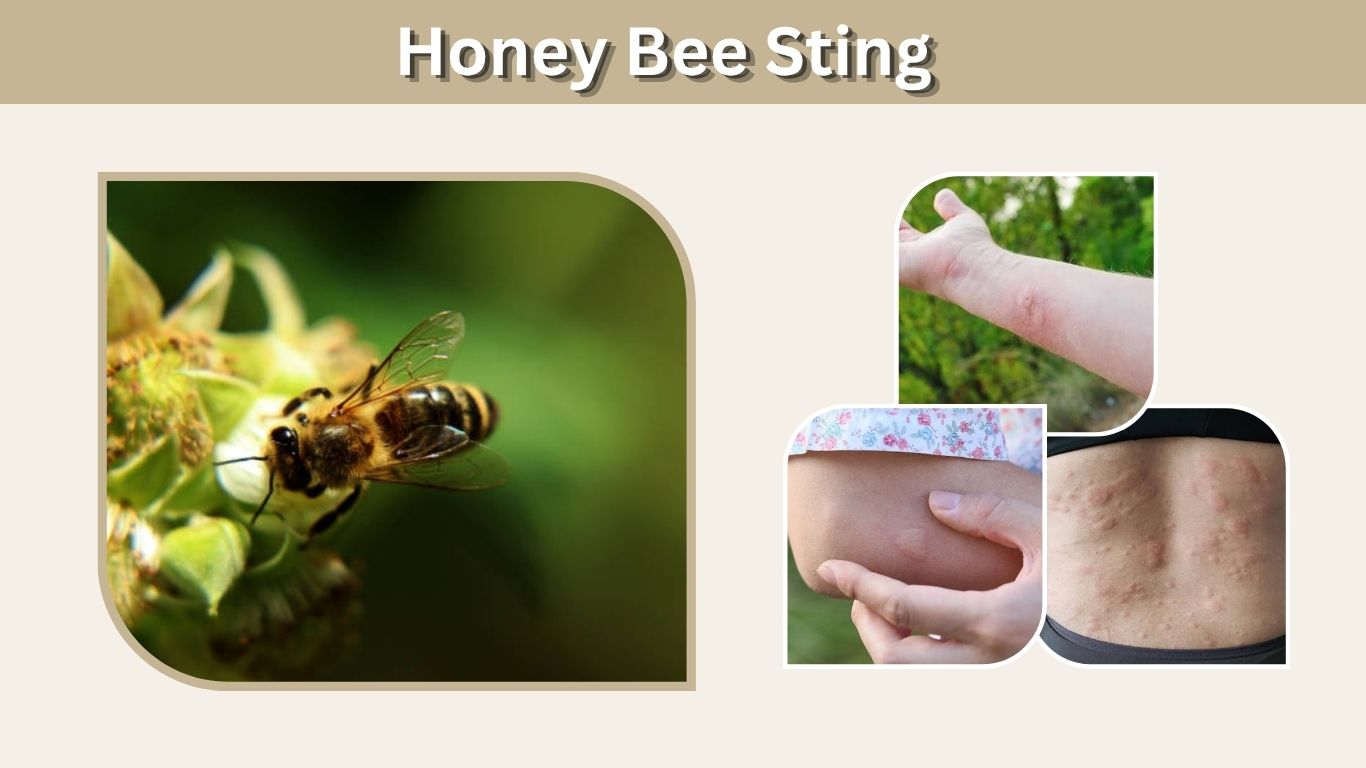 Honey Bee Sting: Symptoms, Treatment, Swelling & Relief